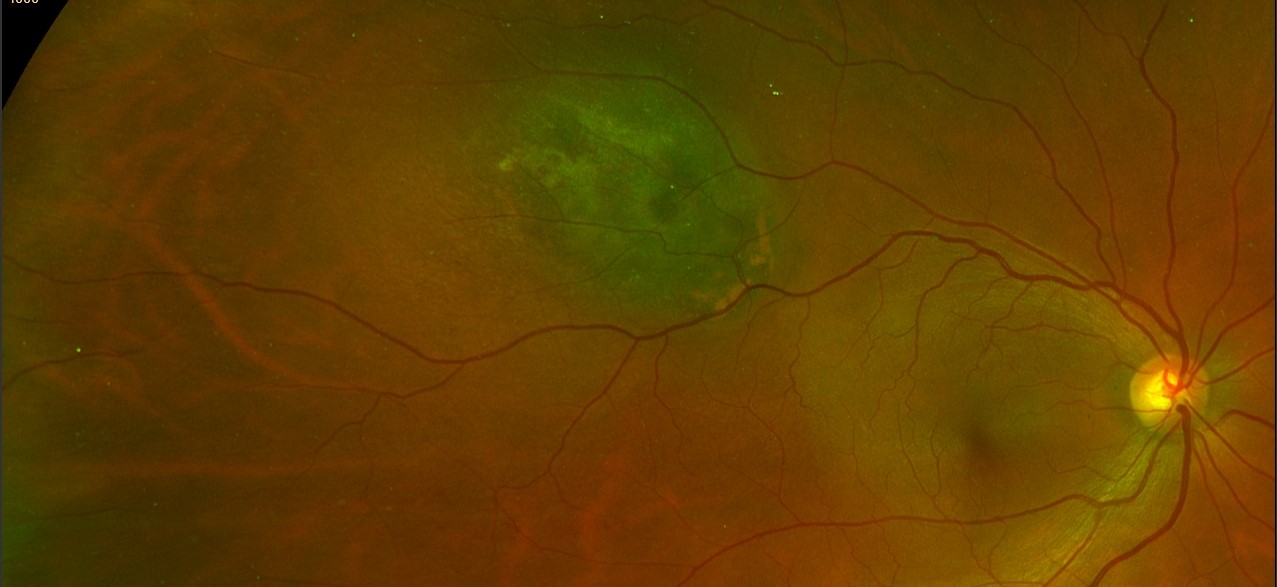 choroidal melanoma
